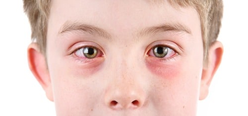 child with pinkeye