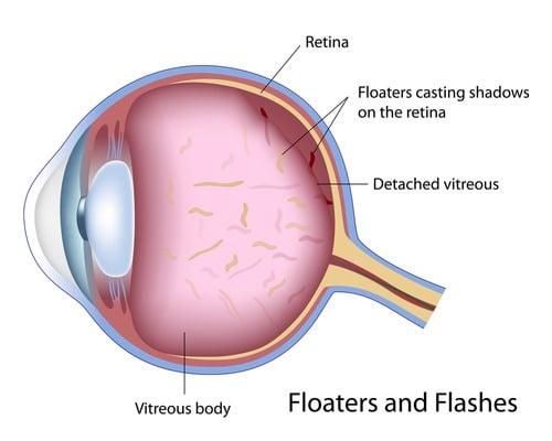 floaters and flashes eye diagram