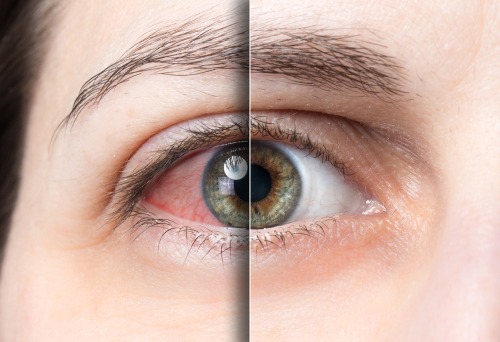 dry eye causes and relief